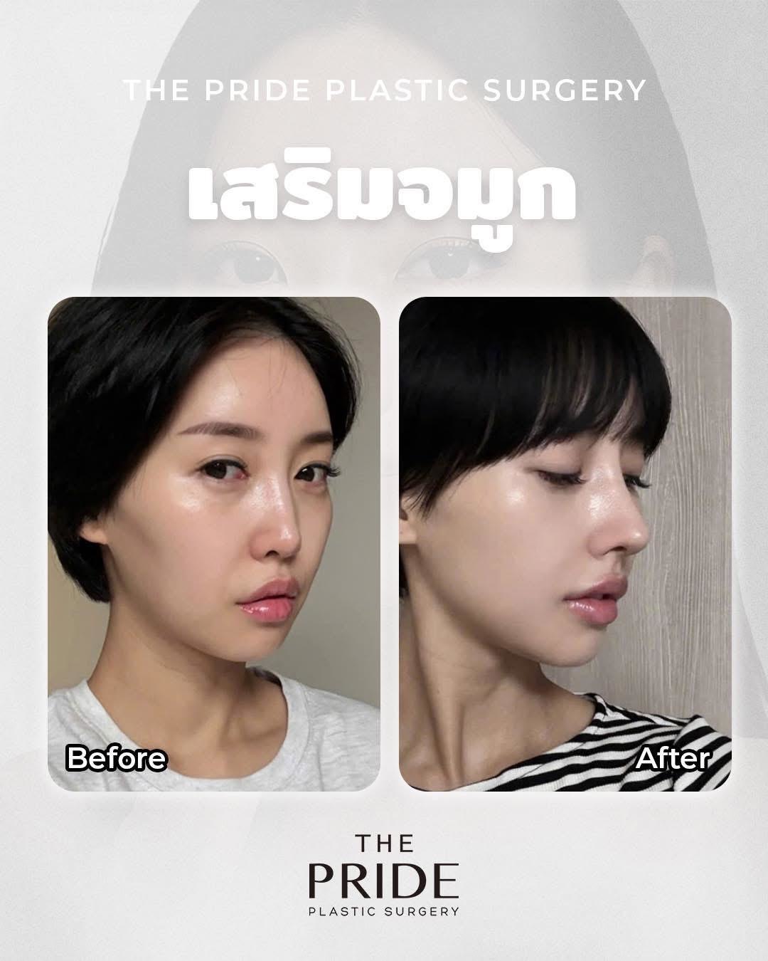 ภาพก่อน–หลังเสริมจมูกจาก The Pride Plastic Surgery