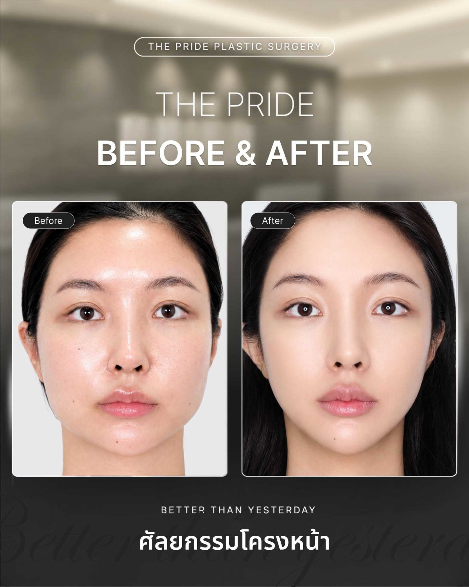 ภาพก่อน–หลังศัลยกรรมโครงหน้าจาก The Pride Plastic Surgery
